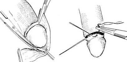 包皮手術哪種好?